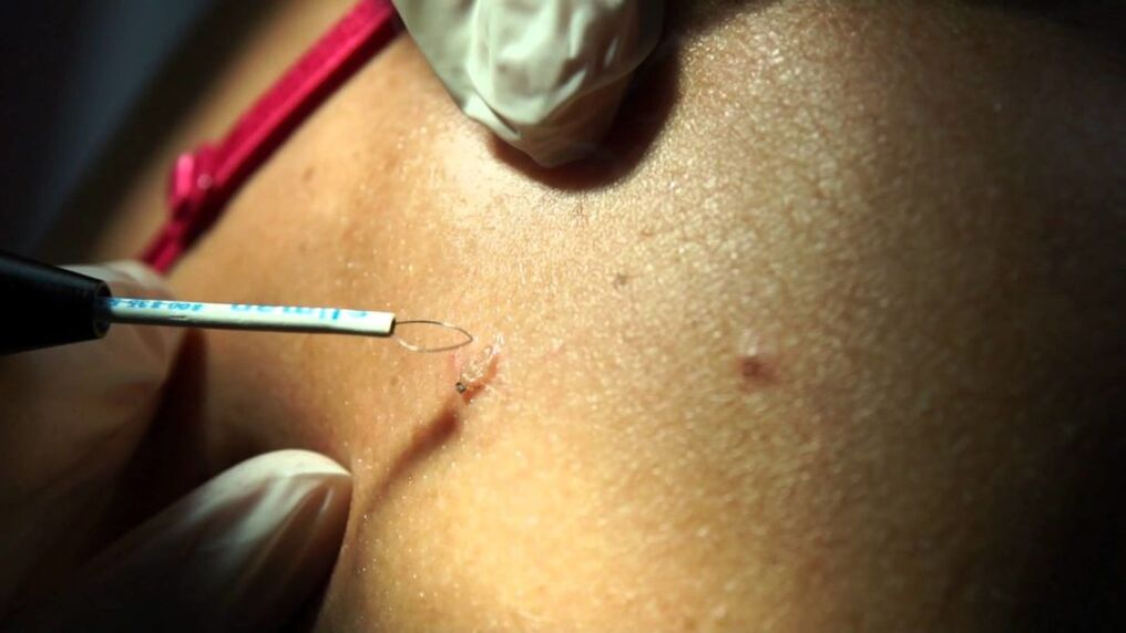 Radio wave removal from papilloma