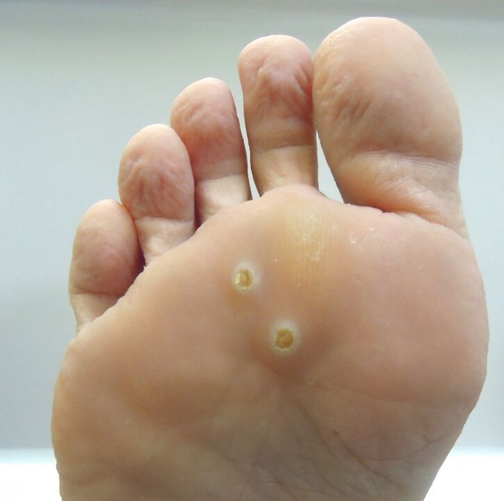 How to get rid of warts on foot