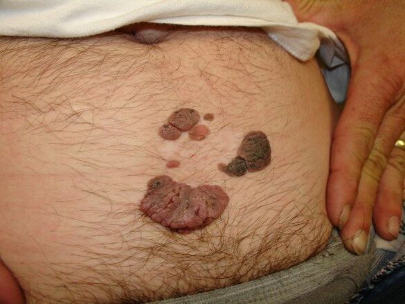 Papillomas on a man's stomach