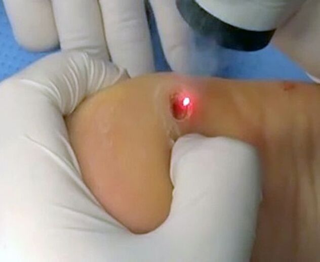 The procedure for removing warts on the heel with a laser