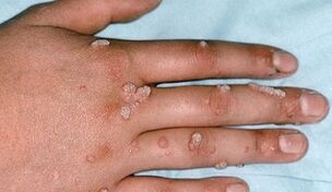 Types of warts and methods of removing them