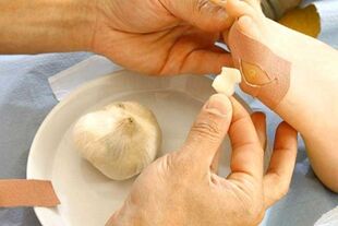 Treatment of papillomas with garlic compress
