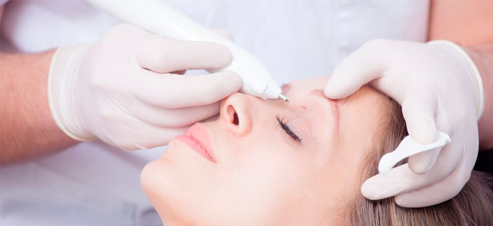 Procedure for removing facial warts with laser